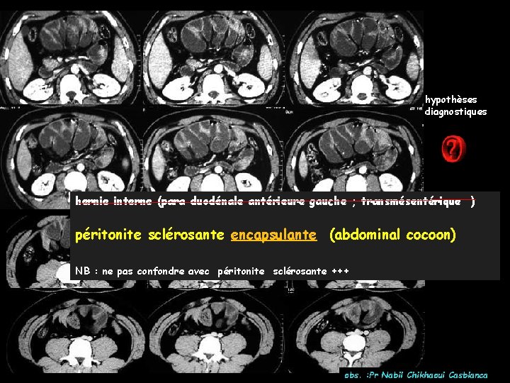 hypothèses diagnostiques hernie interne (para duodénale antérieure gauche ; transmésentérique ) péritonite sclérosante encapsulante