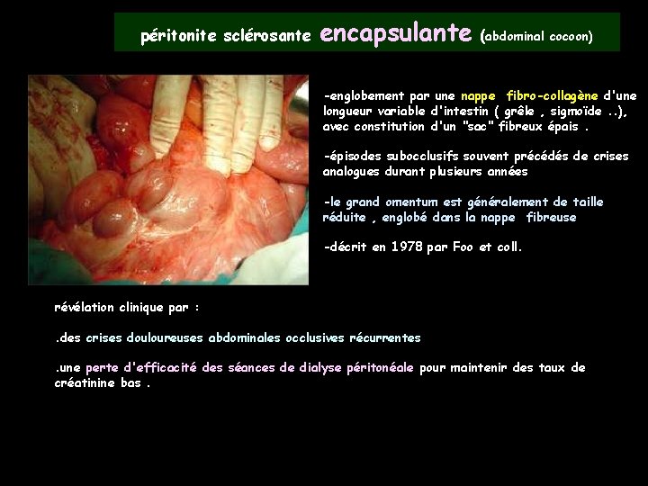 péritonite sclérosante encapsulante (abdominal cocoon) -englobement par une nappe fibro-collagène d'une longueur variable d'intestin