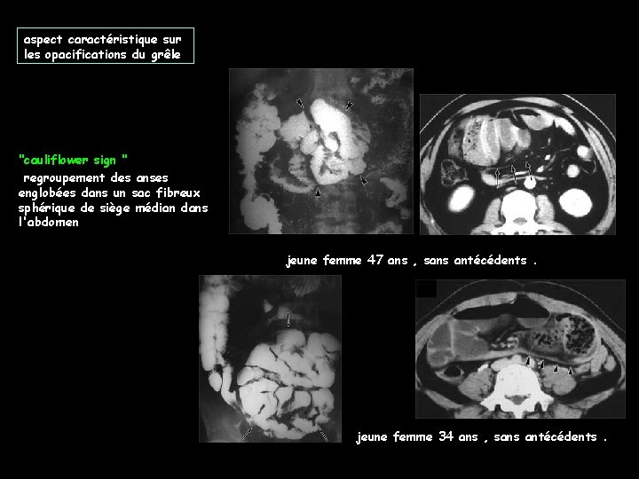 aspect caractéristique sur les opacifications du grêle "cauliflower sign " regroupement des anses englobées