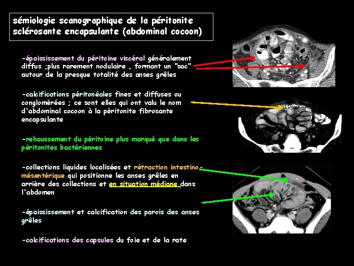 sémiologie scanographique de la péritonite sclérosante encapsulante (abdominal cocoon) -épaississement du péritoine viscéral généralement