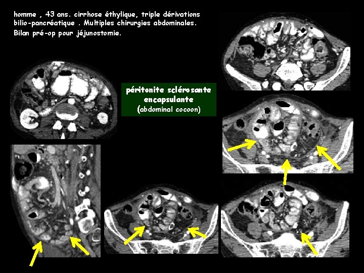 homme , 43 ans. cirrhose éthylique, triple dérivations bilio-pancréatique. Multiples chirurgies abdominales. Bilan pré-op