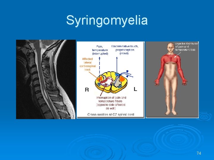 Syringomyelia Rash Disease of Spine and Spinal Cord Assoc Prof
