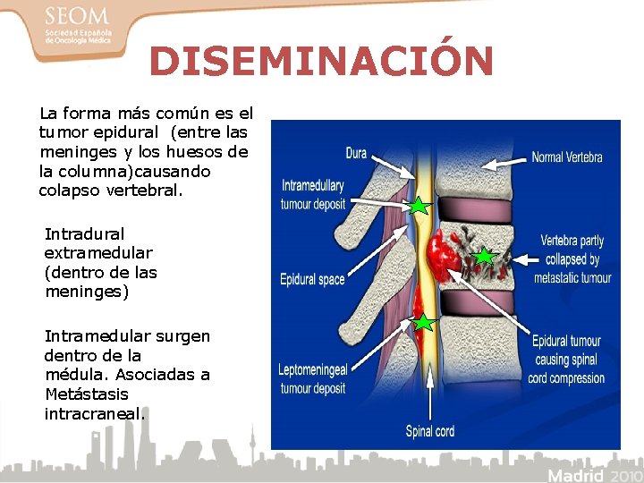 DISEMINACIÓN La forma más común es el tumor epidural (entre las meninges y los