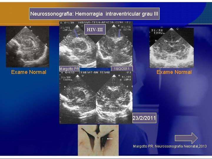 Neurossonografia: Hemorragia intraventricular grau III HIV-III Exame Normal Margotto PR 18/2/2011 Exame Normal 23/2/2011