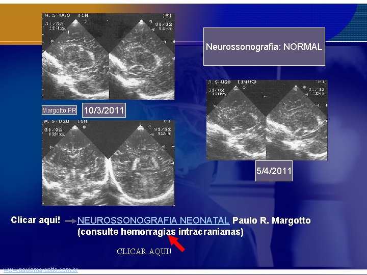 Neurossonografia: NORMAL 10/3/2011 Margotto PR 5/4/2011 Clicar aqui! NEUROSSONOGRAFIA NEONATAL Paulo R. Margotto (consulte