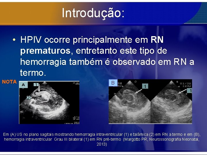 Introdução: • HPIV ocorre principalmente em RN prematuros, entretanto este tipo de hemorragia também