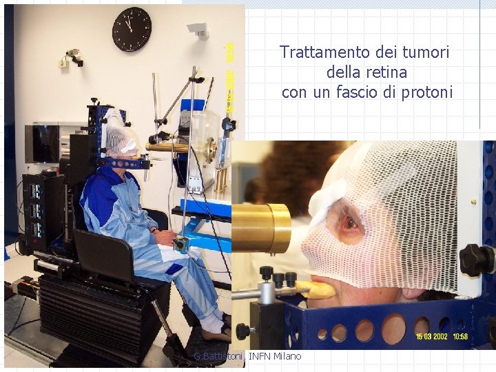 Trattamento dei tumori della retina con un fascio di protoni G. Battistoni, INFN Milano
