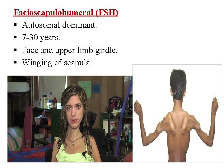Facioscapulohumeral (FSH) Autosomal dominant. 7 -30 years. Face and upper limb girdle. Winging of