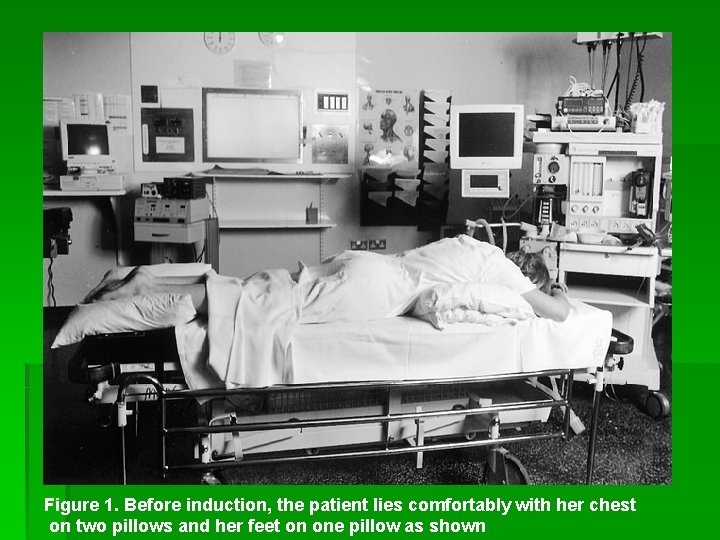 Figure 1. Before induction, the patient lies comfortably with her chest on two pillows