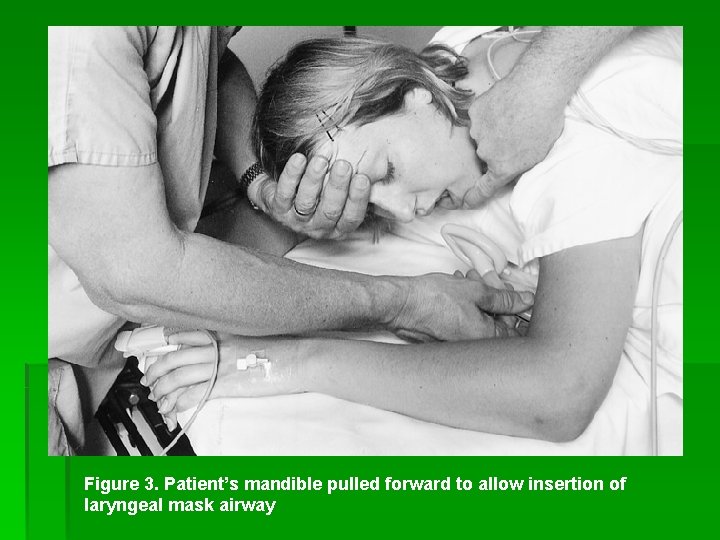 Figure 3. Patient’s mandible pulled forward to allow insertion of laryngeal mask airway 