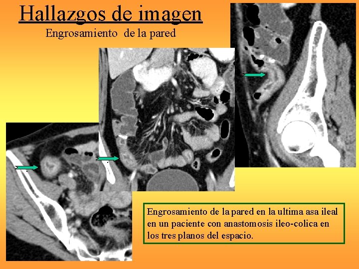 Hallazgos de imagen Engrosamiento de la pared. . . Engrosamiento de la pared en