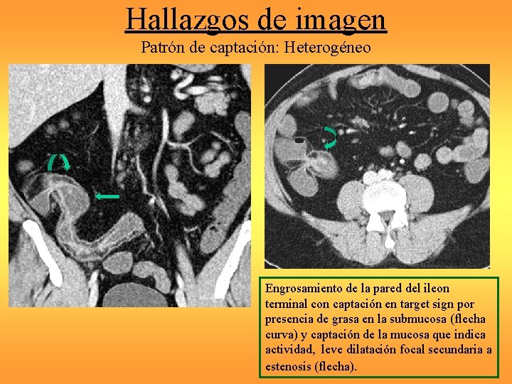 Hallazgos de imagen Patrón de captación: Heterogéneo Engrosamiento de la pared del ileon terminal