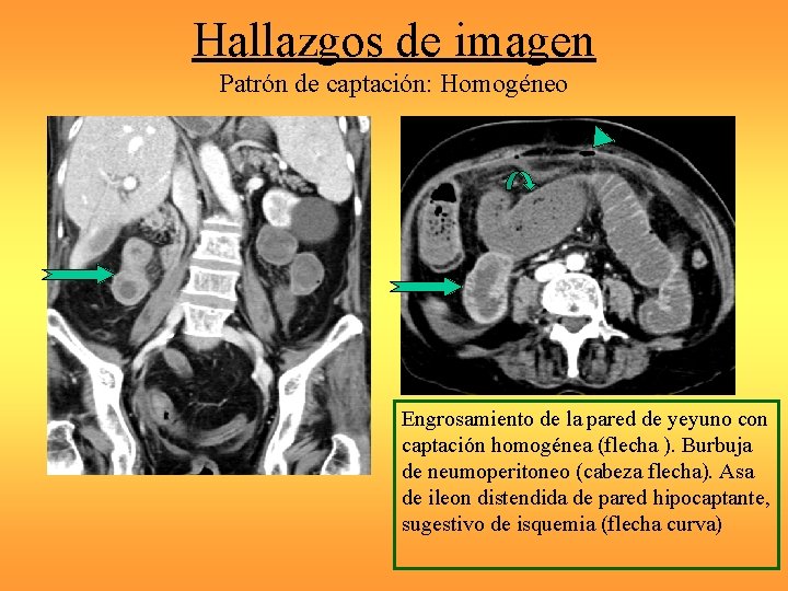 Hallazgos de imagen Patrón de captación: Homogéneo Engrosamiento de la pared de yeyuno con