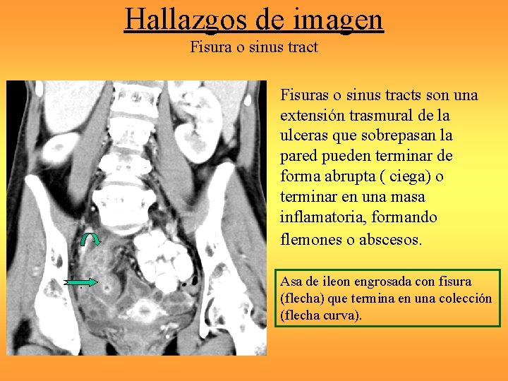 Hallazgos de imagen Fisura o sinus tract Fisuras o sinus tracts son una extensión