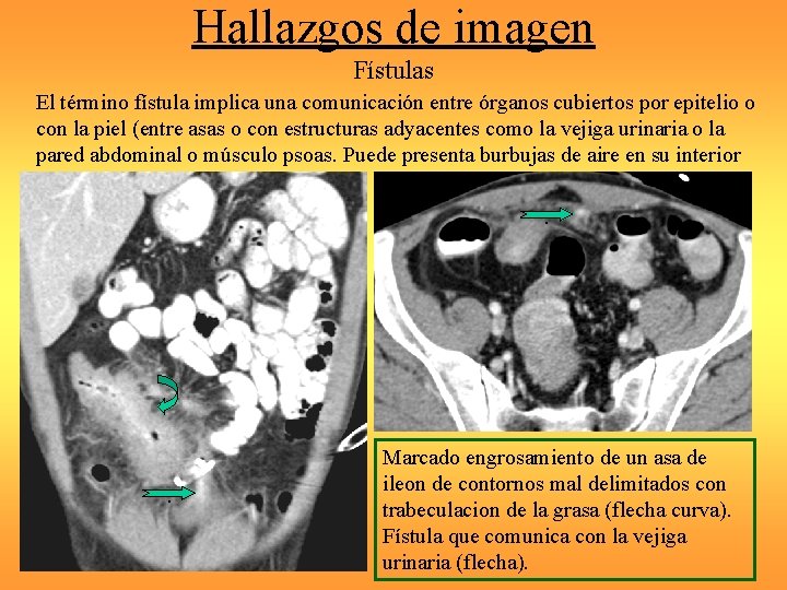 Hallazgos de imagen Fístulas El término fístula implica una comunicación entre órganos cubiertos por