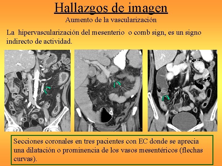 Hallazgos de imagen Aumento de la vascularización La hipervascularización del mesenterio o comb sign,