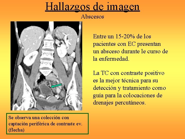 Hallazgos de imagen Abscesos Entre un 15 -20% de los pacientes con EC presentan