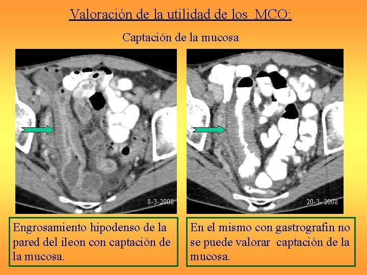 Valoración de la utilidad de los MCO: Captación de la mucosa 8 -3 -2008