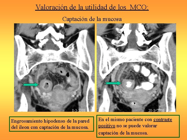 Valoración de la utilidad de los MCO: Captación de la mucosa 8 -3 -2008