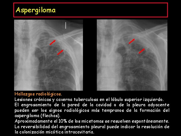 Aspergiloma Hallazgos radiológicos. Lesiones crónicas y caverna tuberculosa en el lóbulo superior izquierdo. El