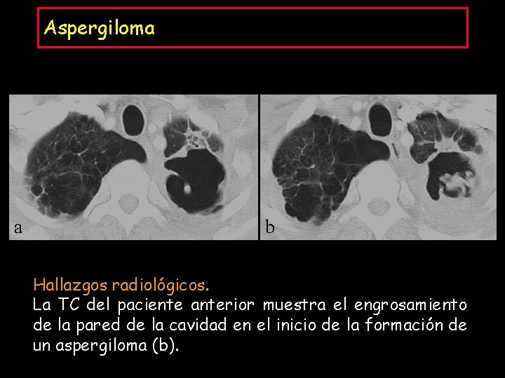Aspergiloma a b Hallazgos radiológicos. La TC del paciente anterior muestra el engrosamiento de