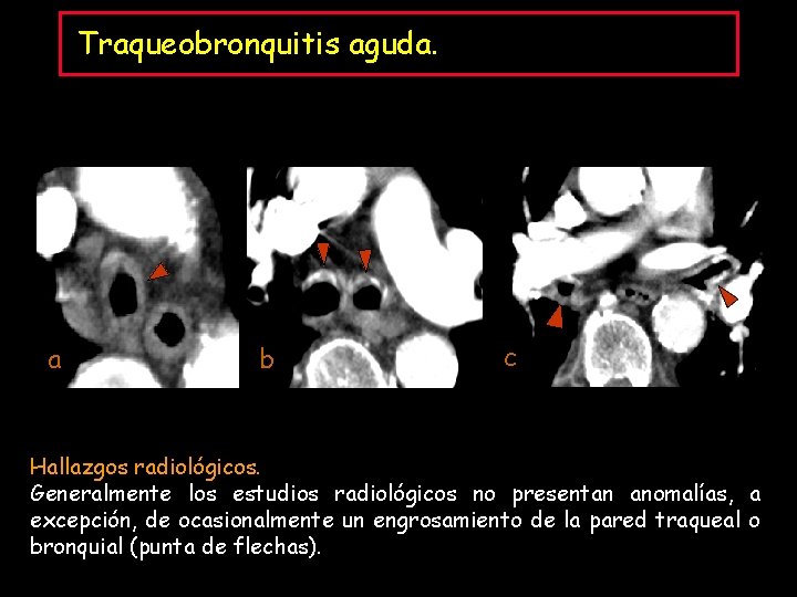 Traqueobronquitis aguda. a b c Hallazgos radiológicos. Generalmente los estudios radiológicos no presentan anomalías,