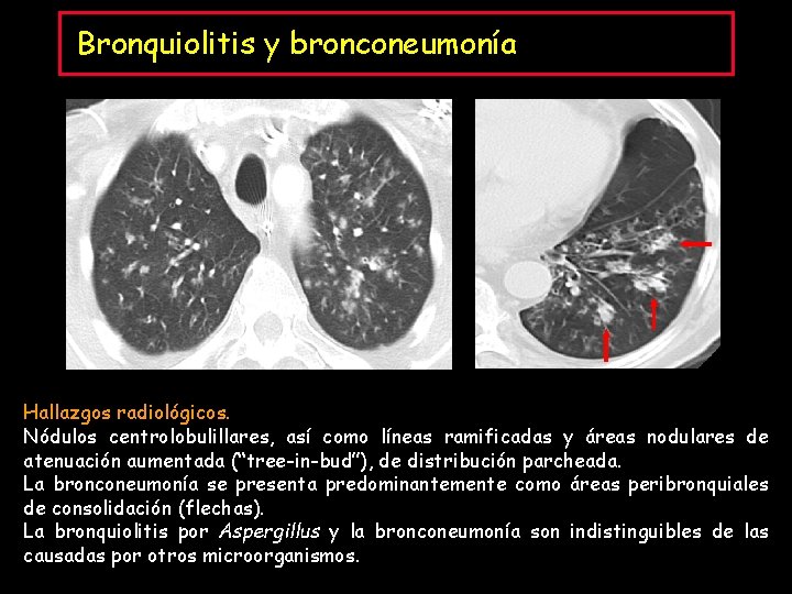 Bronquiolitis y bronconeumonía Hallazgos radiológicos. Nódulos centrolobulillares, así como líneas ramificadas y áreas nodulares