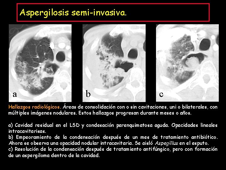 Aspergilosis semi-invasiva. a b c Hallazgos radiológicos. Áreas de consolidación con o sin cavitaciones,