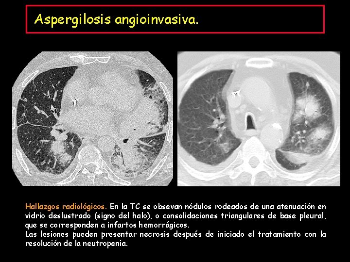 Aspergilosis angioinvasiva. Hallazgos radiológicos. En la TC se obsevan nódulos rodeados de una atenuación