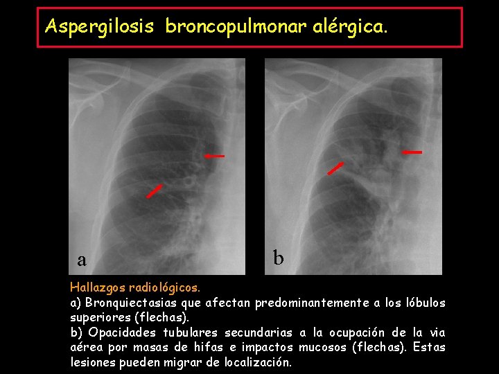 Aspergilosis broncopulmonar alérgica. a b Hallazgos radiológicos. a) Bronquiectasias que afectan predominantemente a los