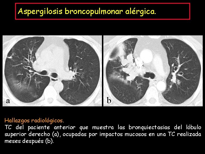 Aspergilosis broncopulmonar alérgica. a b Hallazgos radiológicos. TC del paciente anterior que muestra las