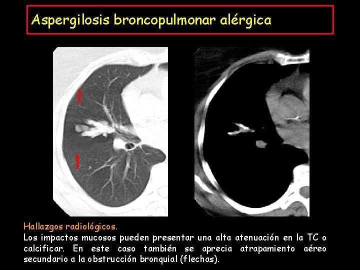 Aspergilosis broncopulmonar alérgica Hallazgos radiológicos. Los impactos mucosos pueden presentar una alta atenuación en