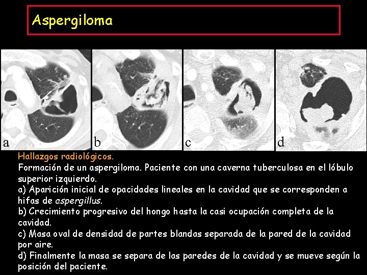 Aspergiloma a b c d Hallazgos radiológicos. Formación de un aspergiloma. Paciente con una