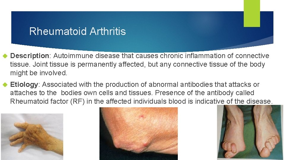 Rheumatoid Arthritis Description: Autoimmune disease that causes chronic inflammation of connective tissue. Joint tissue