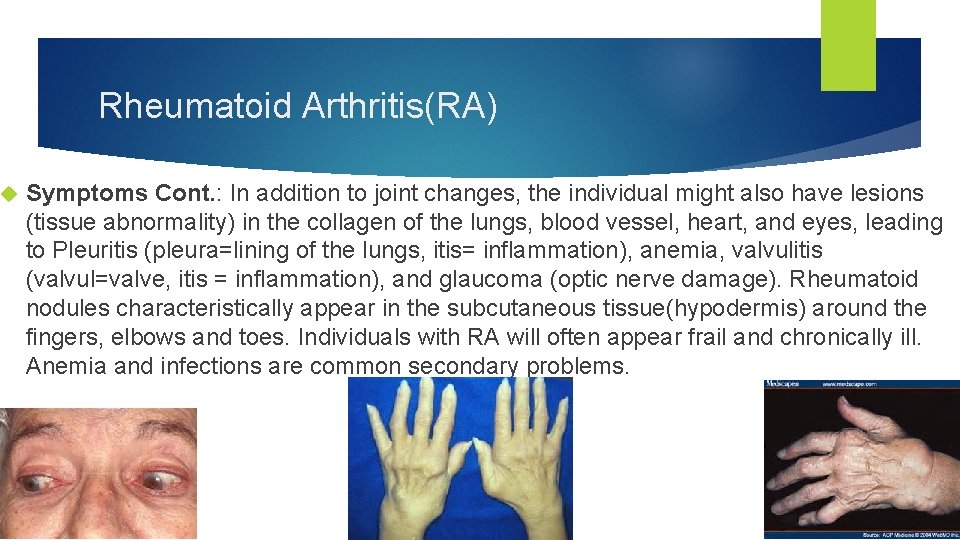  Rheumatoid Arthritis(RA) Symptoms Cont. : In addition to joint changes, the individual might