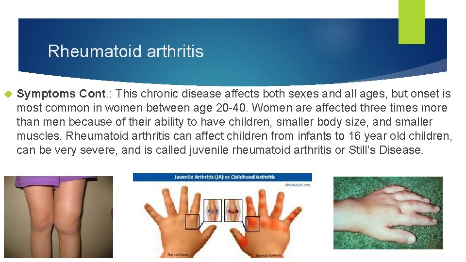Rheumatoid arthritis Symptoms Cont. : This chronic disease affects both sexes and all ages,