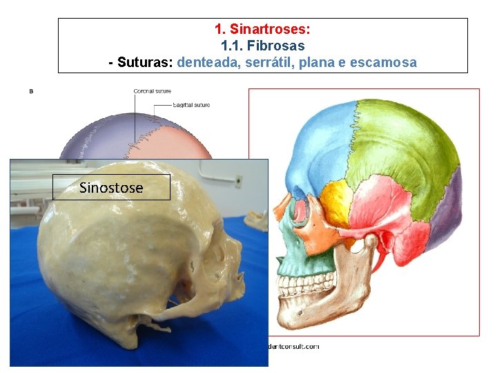 1. Sinartroses: 1. 1. Fibrosas - Suturas: denteada, serrátil, plana e escamosa Sinostose 