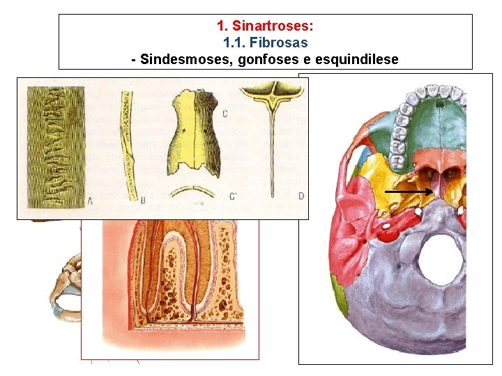 1. Sinartroses: 1. 1. Fibrosas - Sindesmoses, gonfoses e esquindilese 