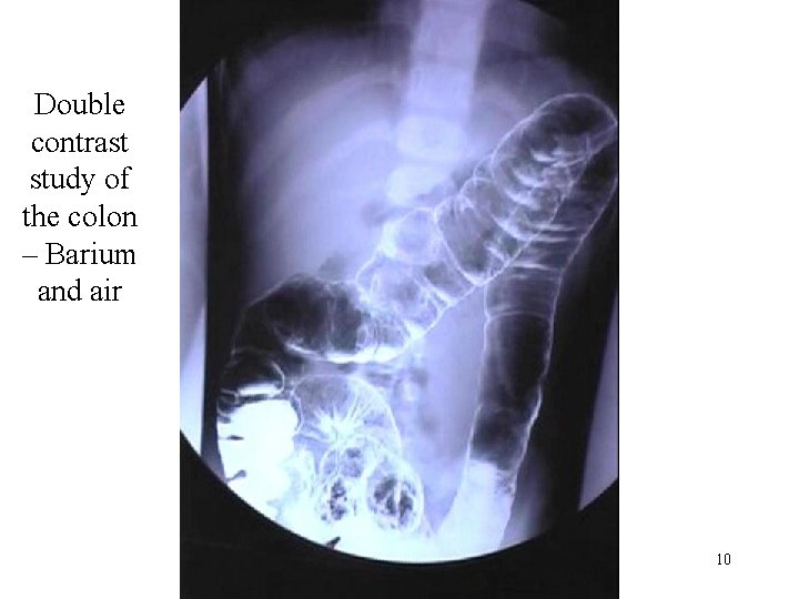 Double contrast study of the colon – Barium and air 10 