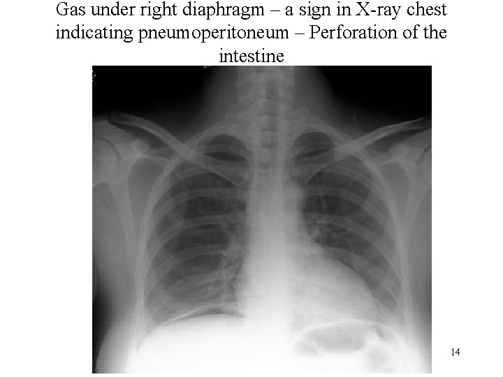 Gas under right diaphragm – a sign in X-ray chest indicating pneumoperitoneum – Perforation