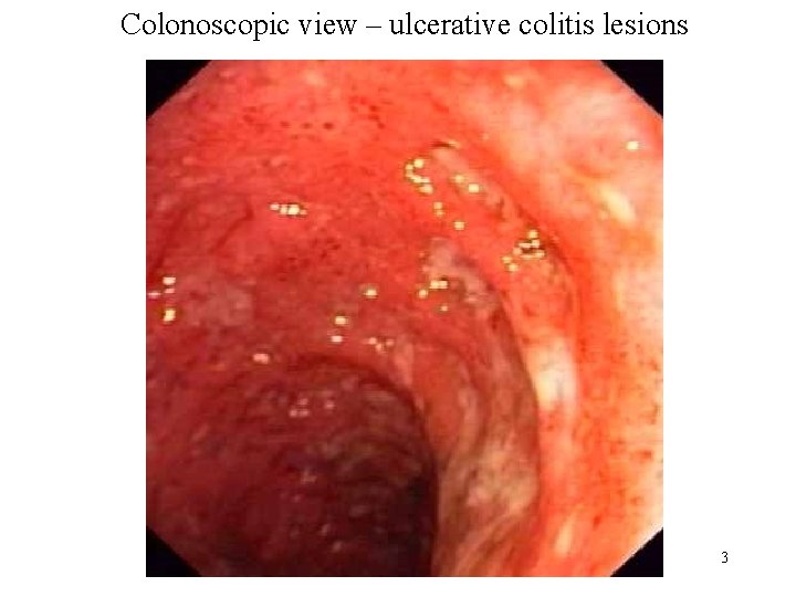 Colonoscopic view – ulcerative colitis lesions 3 