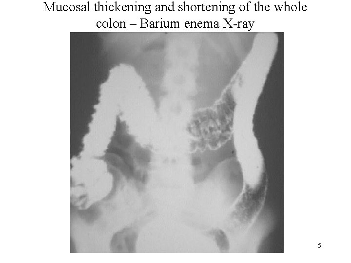 Mucosal thickening and shortening of the whole colon – Barium enema X-ray 5 
