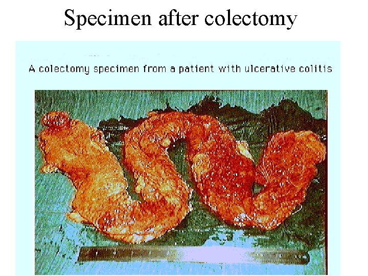 Specimen after colectomy 6 