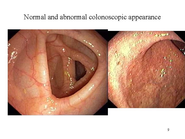 Normal and abnormal colonoscopic appearance 9 