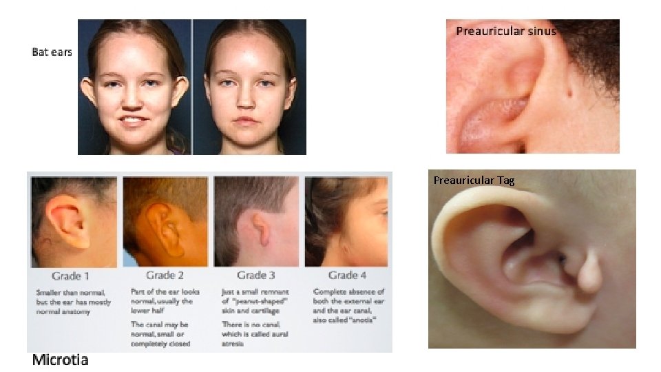 Preauricular Tag 