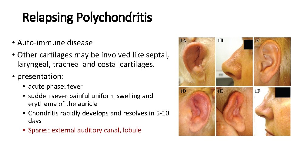 Relapsing Polychondritis • Auto-immune disease • Other cartilages may be involved like septal, laryngeal,