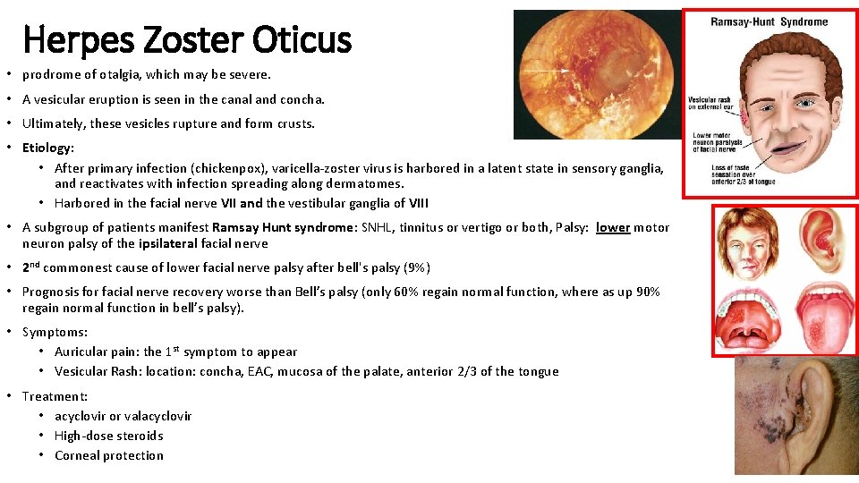 Herpes Zoster Oticus • prodrome of otalgia, which may be severe. • A vesicular