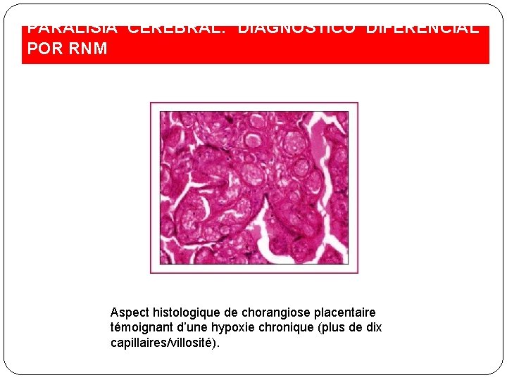 PARALISIA CEREBRAL: DIAGNÓSTICO DIFERENCIAL POR RNM Aspect histologique de chorangiose placentaire témoignant d’une hypoxie