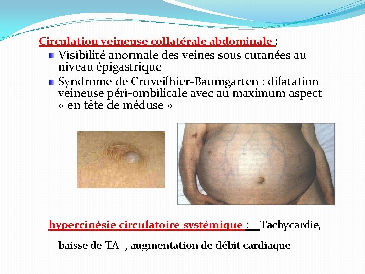 Circulation veineuse collatérale abdominale : Visibilité anormale des veines sous cutanées au niveau épigastrique