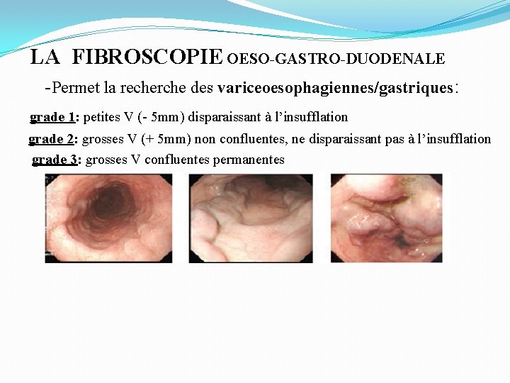 LA FIBROSCOPIE OESO-GASTRO-DUODENALE -Permet la recherche des variceoesophagiennes/gastriques: grade 1: petites V (- 5